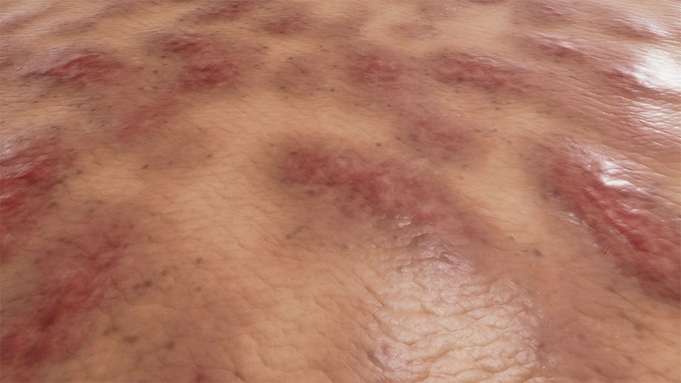 Mild Atopic Dermatitis