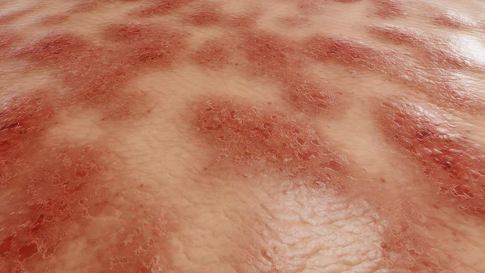 Moderate Atopic Dermatitis
