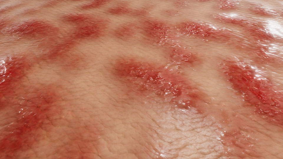 Atopic Dermatitis