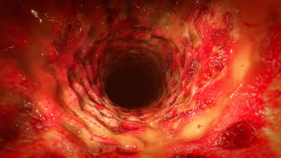 Severe UC
