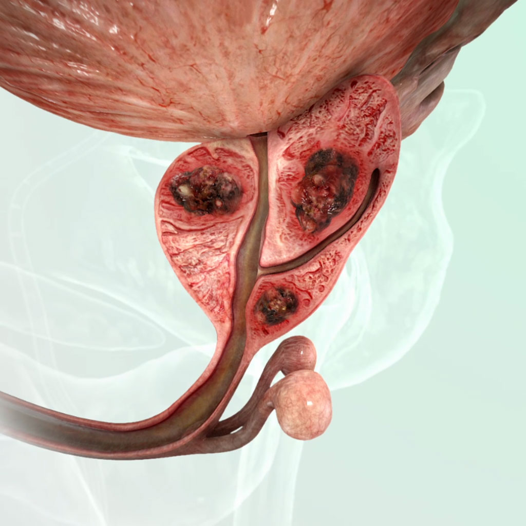 What is prostate cancer?