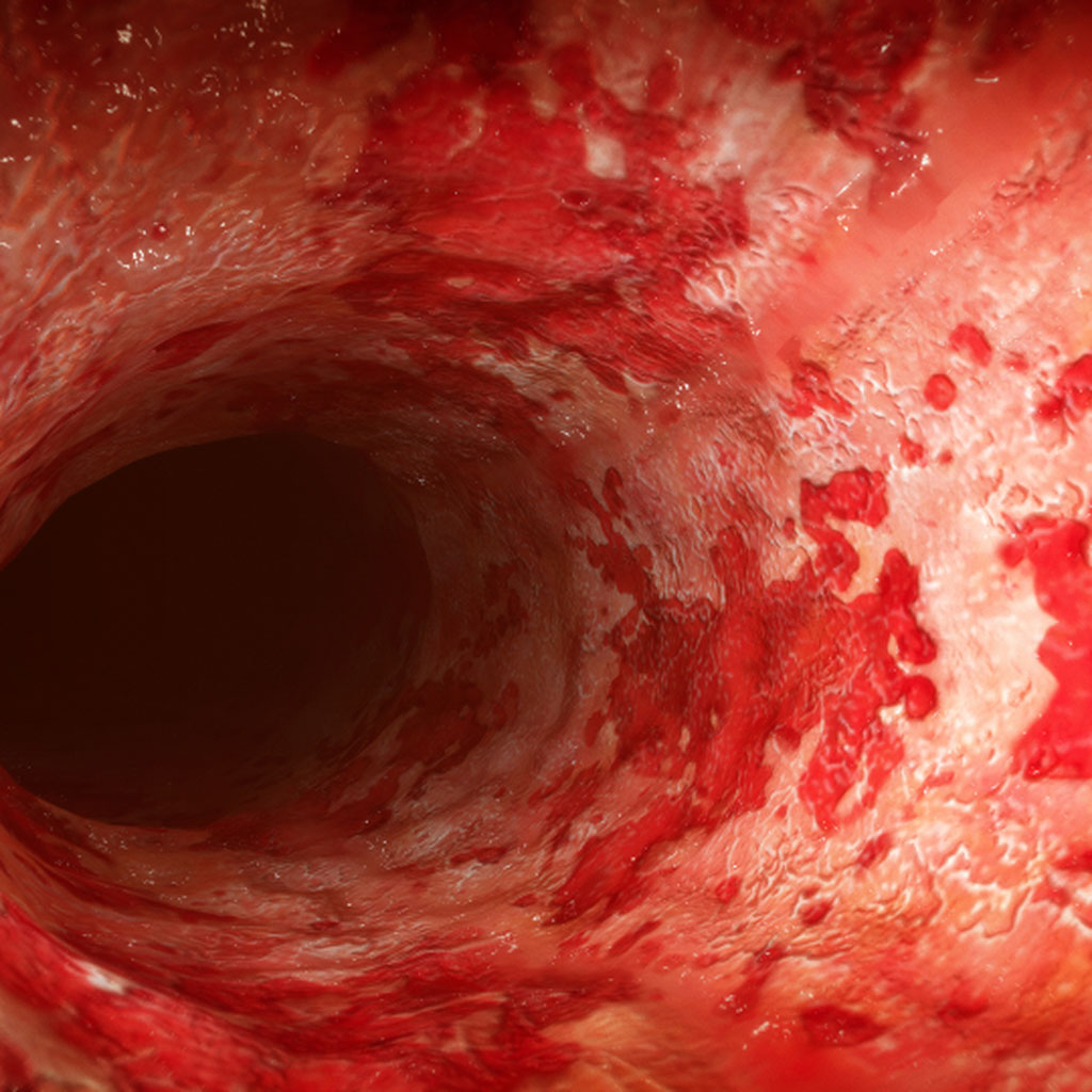 What is Ulcerative Colitis?